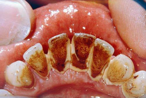 Chẳng cần đến nha sĩ bạn cũng có răng trắng bóc với 2 cách làm trắng răng tại nhà - 6