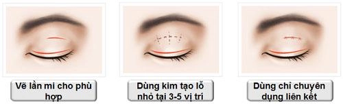 Chi tiền và mạo hiểm dao kéo nhưng bạn có biết nhấn mí kéo dài được bao lâu không - 1