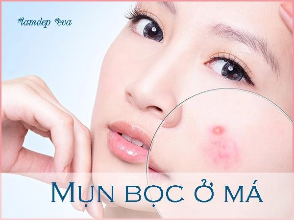 Ngày nào cũng làm theo mụn bọc ở má nặng cỡ nào cũng bị xóa mờ cực nhanh - 1