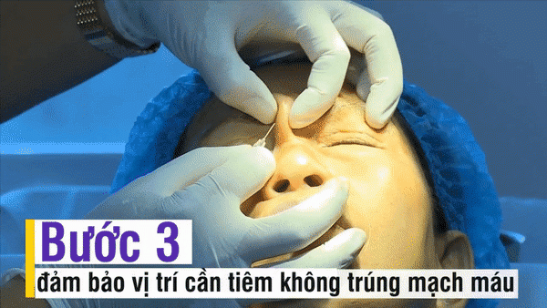 Nhẹ nhàng không đau không chảy máu bảo sao người người nhà nhà dẫn nhau đi tiêm filler - 6