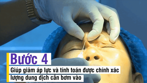 Nhẹ nhàng không đau không chảy máu bảo sao người người nhà nhà dẫn nhau đi tiêm filler - 8