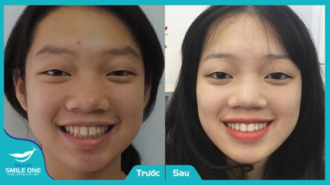 Sở hữu hàm răng bền đẹp với giá ưu đãi nhất từ trước đến nay tại nha khoa smile one - 1