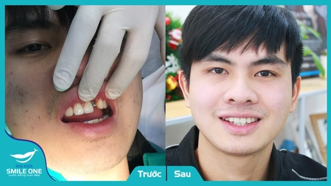 Sở hữu hàm răng bền đẹp với giá ưu đãi nhất từ trước đến nay tại nha khoa smile one - 3