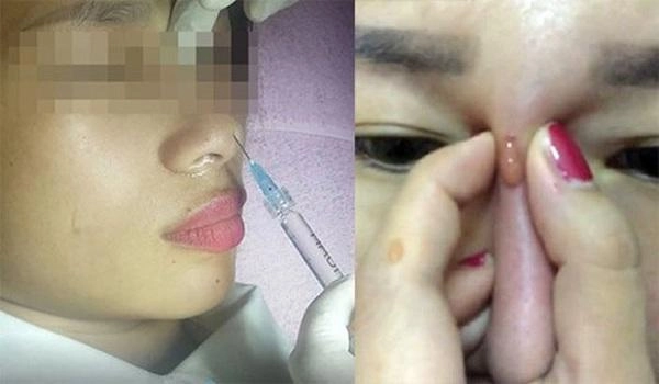 Cảnh báo lại có thêm 1 phụ nữ méo mặt mũi bọc mủ vì tiêm filler làm đẹp - 3