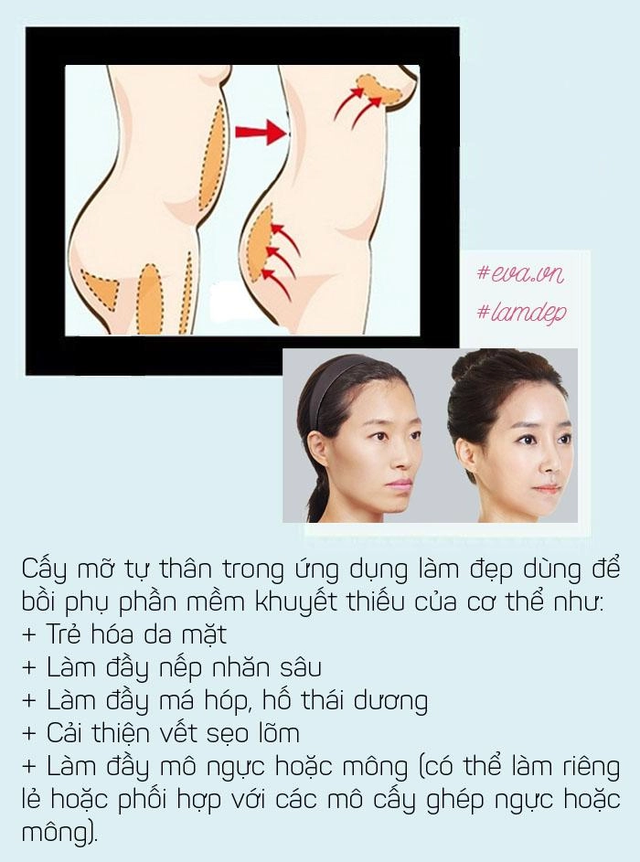 Cấy mỡ ở bụng rồi tiêm lên mặt da được trẻ hóa vĩnh viễn thực hư ra sao - 3