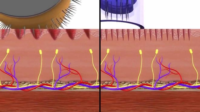 Lăn kim phương pháp an toàn và hiệu quả điều trị sẹo rỗ nám da - 4