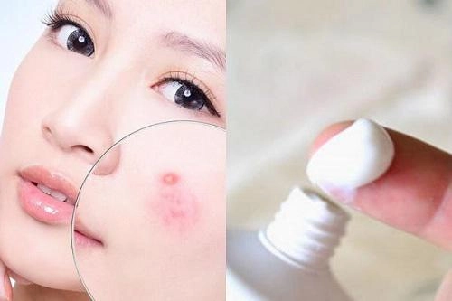 Bất ngờ trước cách trị mụn bọc chẳng tốn bao nhiêu tiền với kem đánh răng - 5