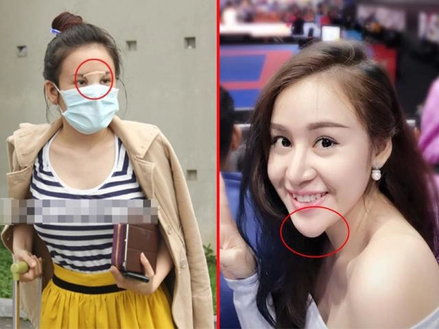 Biến dạng kinh khủng cả khuôn mặt vì tẩy nốt ruồi sai cách chị em nên cảnh giác cao độ - 9