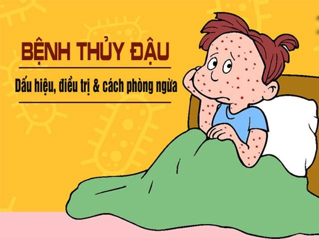 4 sai lầm nói mãi mẹ không nhớ khi chữa thủy đậu cho con khiến bé nặng bệnh - 4