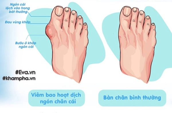 Con gái 1 tuổi kiếm 10 tỷ của đại gia đoàn di băng được phát hiện bị tật ở bàn chân bắt đầu tiến hành điều trị - 15