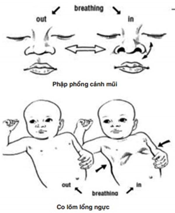 Cách điều trị các bệnh hô hấp khi chuyển mùa ở trẻ - 1