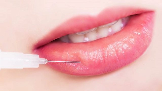 Đẹp đâu chưa thấy chị em ham tiêm filler môi gặp biến chứng đáng ngại - 1