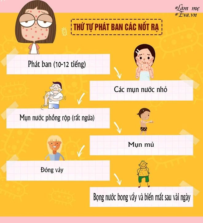 Khi trẻ bị thủy đậu thứ tự phát ban các nốt bỏng rạ sẽ như thế nào - 2