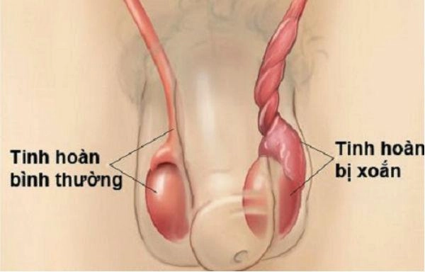 Tưởng con đau bụng thường mẹ hưng yên ngỡ ngàng khi bác sĩ nói phải cắt bỏ tinh hoàn - 2