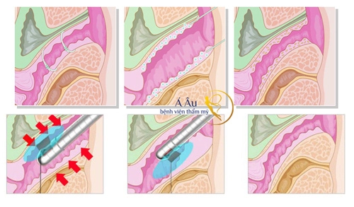 Vùng kín lỏng lẻo sau sinh - nỗi lòng của chị em phụ nữ - 2