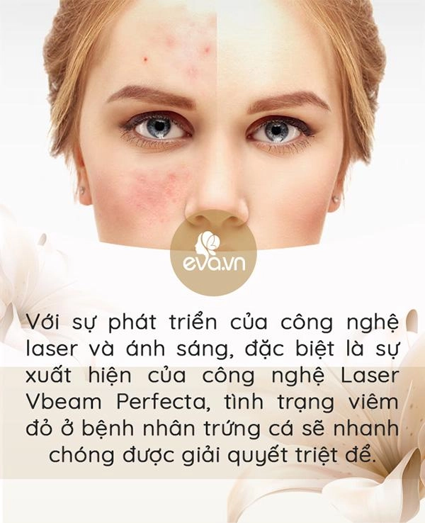 3 ngày nữa noel 7 ngày nữa tết tây làm sao trị mụn trứng cá nhanh mà còn an toàn - 3