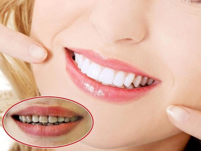 Tẩy trắng răng và những lưu ý cần biết về làm trắng răng tại nhà - 5