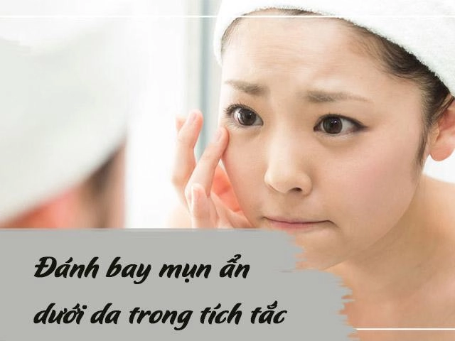 10 cách trị mụn ẩn dưới da tại nhà an toàn hiệu quả nhanh nhất - 13
