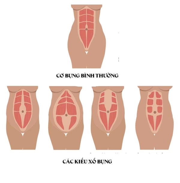 Gạt bỏ mối lo xổ bụng sau sinh nếu biết những cách phòng ngừa hiệu quả - 1