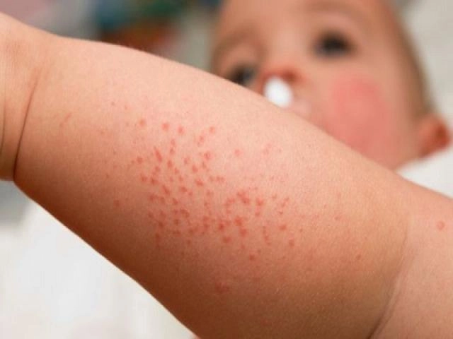 Dấu hiệu sốt xuất huyết ở trẻ em theo giai đoạn bệnh - 5