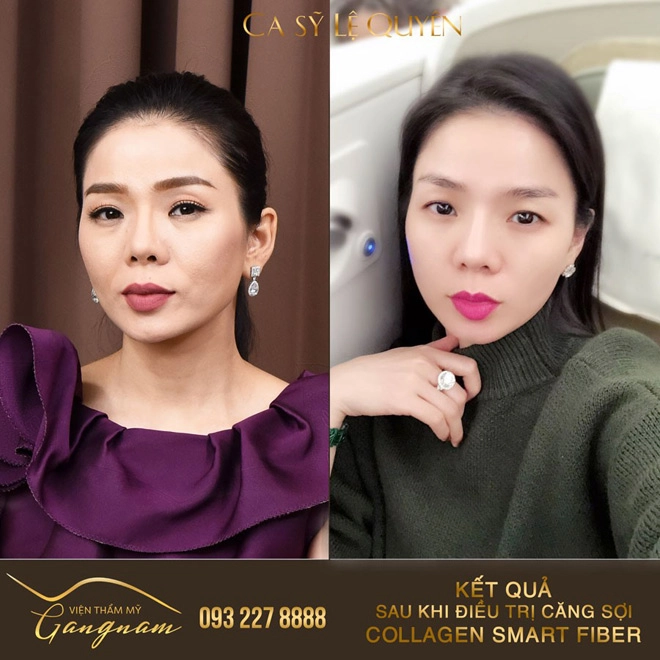 Không nghi ngờ gì nữa đây là công nghệ được rất nhiều sao việt chọn để cải lão hoàn đồng - 1