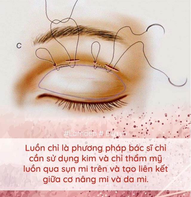 Làm đẹp thế nào khi cứ mãi lẫn lộn nhấn mí với cắt mí đây là điều bạn cần biết - 4