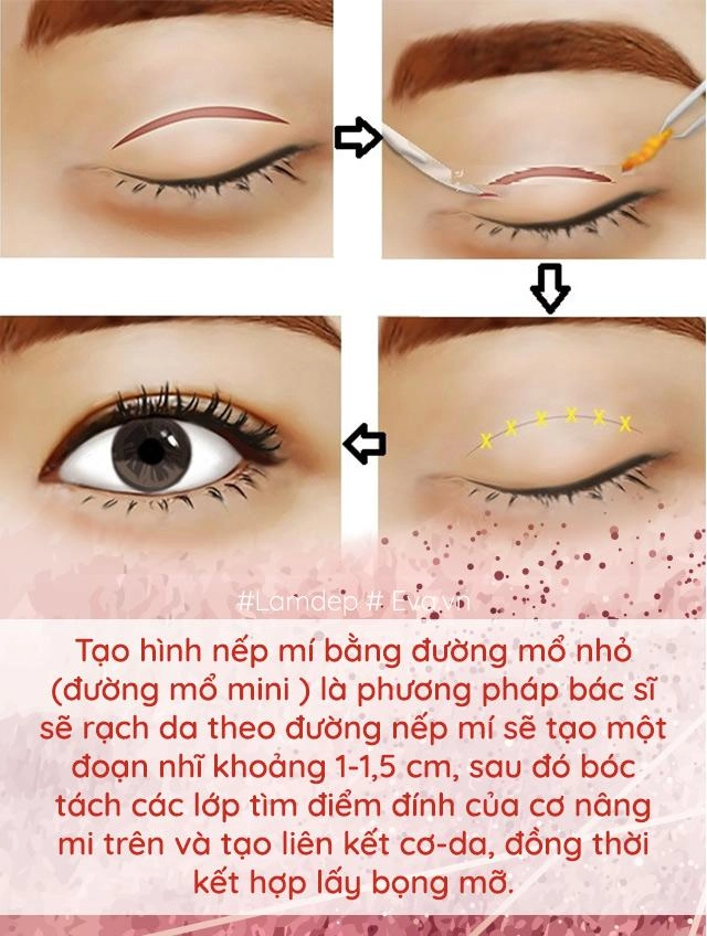 Làm đẹp thế nào khi cứ mãi lẫn lộn nhấn mí với cắt mí đây là điều bạn cần biết - 5