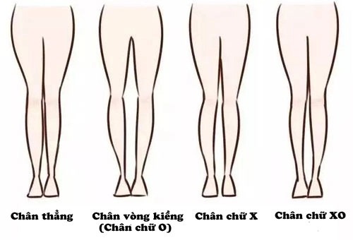 Mẹo chọn đồ khắc phục dáng chân chữ bát chân vòng kiềng - 1
