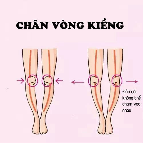 Mẹo chọn đồ khắc phục dáng chân chữ bát chân vòng kiềng - 2