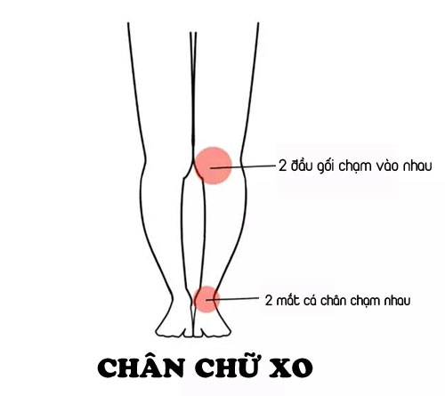 Mẹo chọn đồ khắc phục dáng chân chữ bát chân vòng kiềng - 13