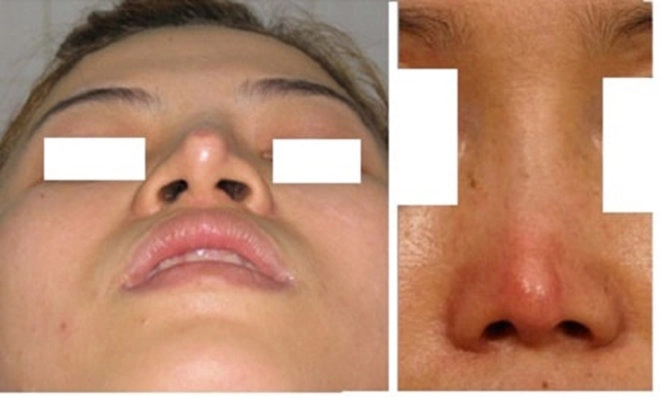 Những hệ lụy đáng tiếc do phẫu thuật nâng mũi mang lại - 4