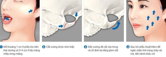 Phương pháp hạ xương gò má mới thực sự là cứu tinh của những nàng có gò má cao - 2