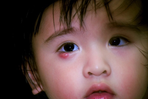 Bác sĩ chỉ cách chữa lẹo chắp ở mắt cho trẻ bằng rau xanh - 1