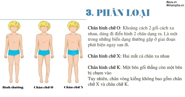 Bác sĩ chỉ cách phát hiện trẻ bị chân vòng kiềng ngay từ nhỏ - 3