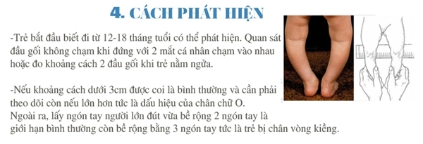 Bác sĩ chỉ cách phát hiện trẻ bị chân vòng kiềng ngay từ nhỏ - 4