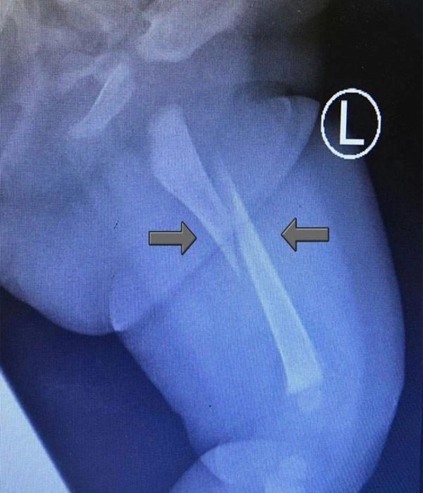 Bé 3 tháng khóc không ngừng khi đi nhà trẻ về bố sốc nặng khi nghe bác sĩ kết luận - 1