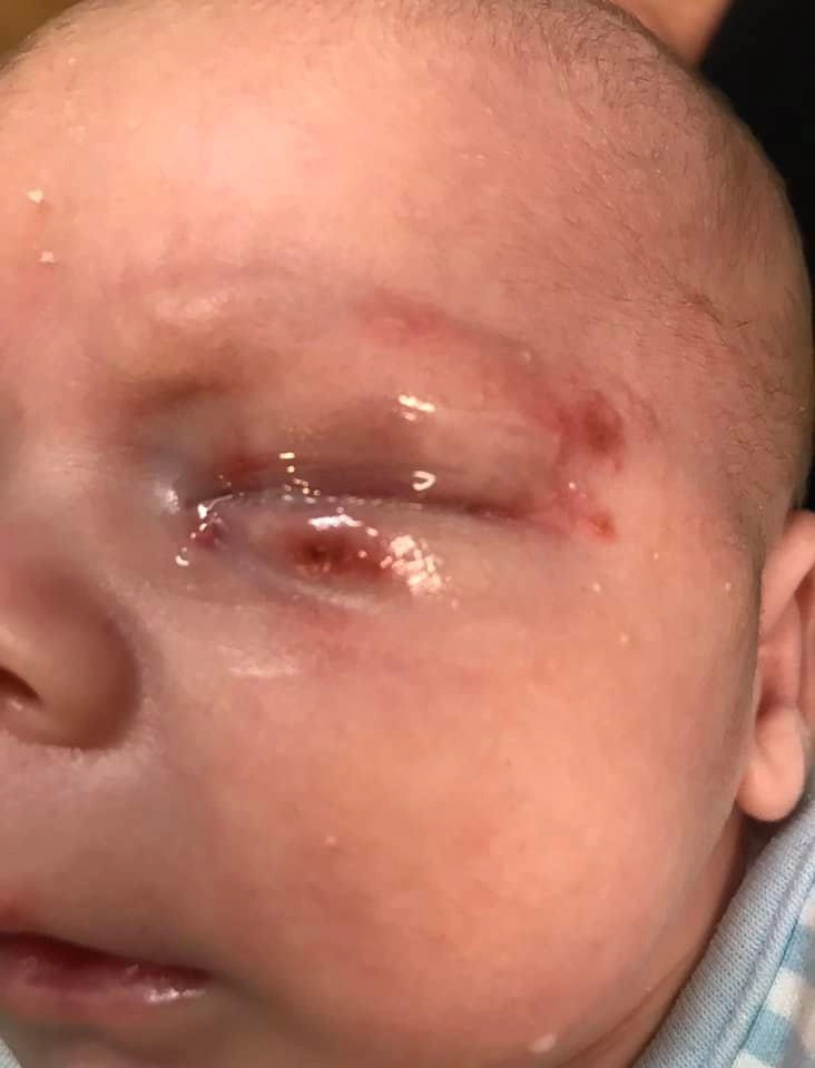 Bị người lạ hôn bé 4 tuần tuổi mắt sưng phồng chảy nước giành giật sự sống - 5