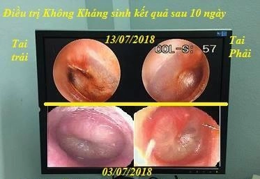 Bị viêm tai giữa dùng 1 tháng kháng sinh không đỡ bé khỏi bệnh sau 10 ngày với cách này - 2