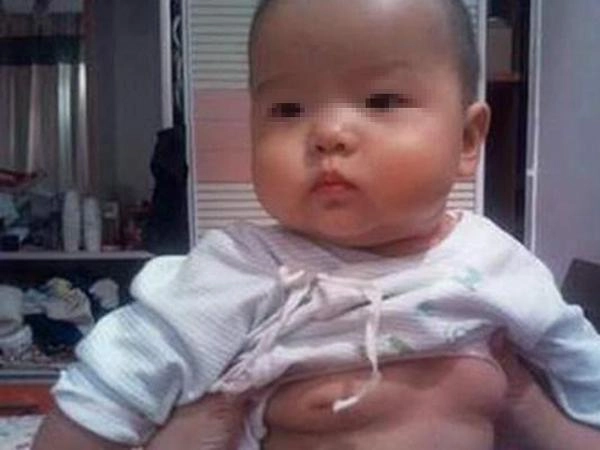 Con gái 2 tuổi ngực lớn bất thường mẹ ôm mặt khóc khi nghe bác sĩ nói nguyên nhân - 2
