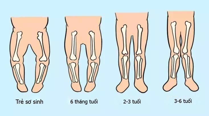 Dấu hiệu bất thường ở chân trẻ mẹ nên cho bé tới bệnh viện sớm - 2