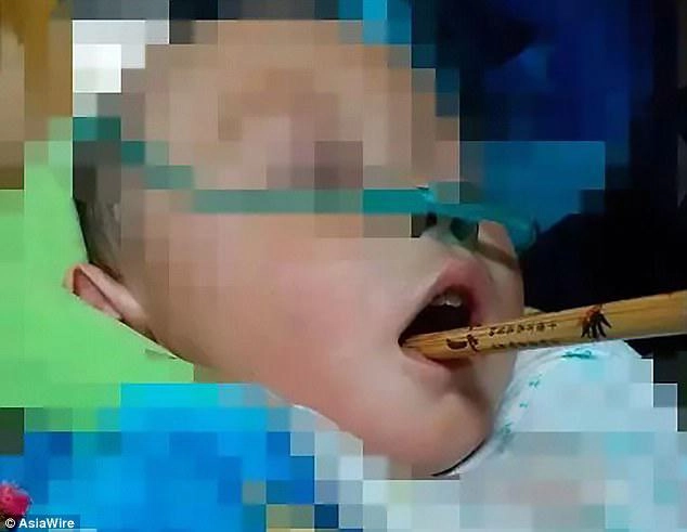 Mẹ bưng bát chạy theo đút cơm bé trai 2 tuổi gặp nạn với chiếc đũa - 1
