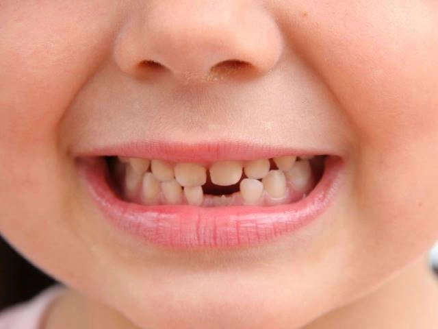 Những lưu ý khi trẻ thay răng sữa để bé sở hữu hàm răng đều và đẹp khi lớn - 3
