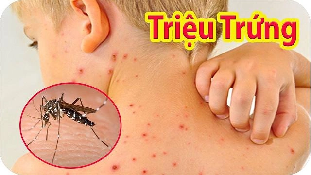 Sốt xuất huyết ở trẻ em 5 triệu chứng phổ biến không được bỏ qua - 3