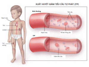 Sốt xuất huyết ở trẻ em 5 triệu chứng phổ biến không được bỏ qua - 6