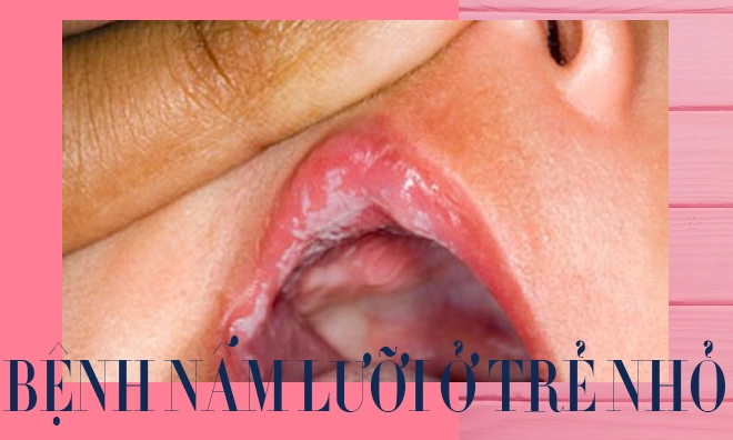 Trẻ bị nấm lưỡi các phương pháp điều trị hiệu quả và an toàn - 1