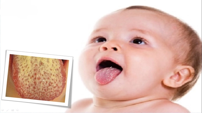 Trẻ bị nấm lưỡi các phương pháp điều trị hiệu quả và an toàn - 2