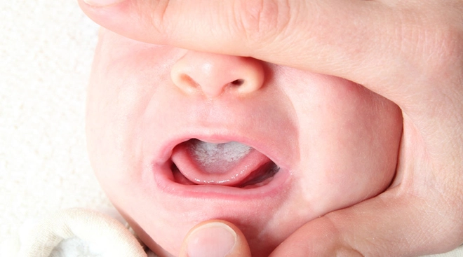 Trẻ bị nấm lưỡi các phương pháp điều trị hiệu quả và an toàn - 3