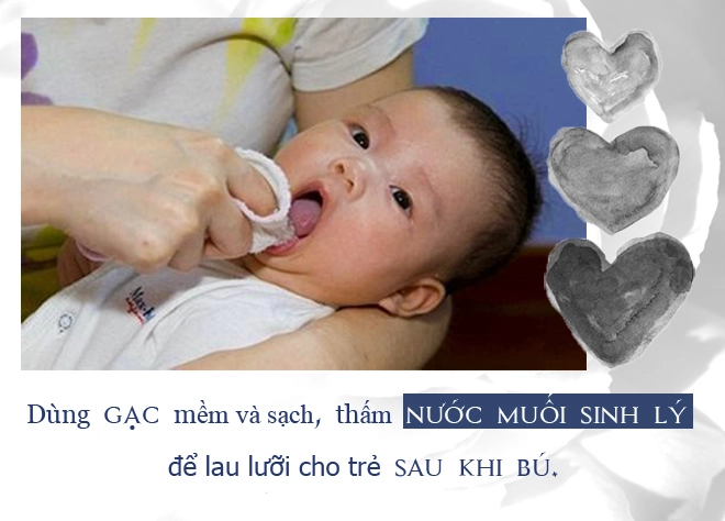 Trẻ bị nấm lưỡi các phương pháp điều trị hiệu quả và an toàn - 4
