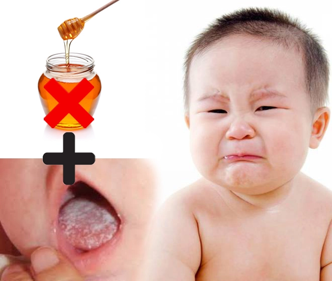 Trẻ bị nấm lưỡi các phương pháp điều trị hiệu quả và an toàn - 5