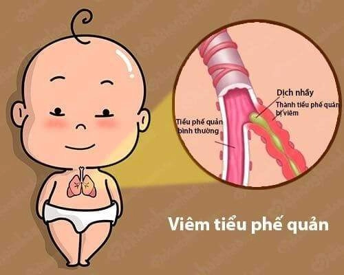 Trẻ bị viêm phế quản dấu hiệu và cách điều trị - 2